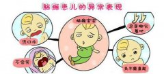 经颅磁治疗仪能治好脑瘫患儿